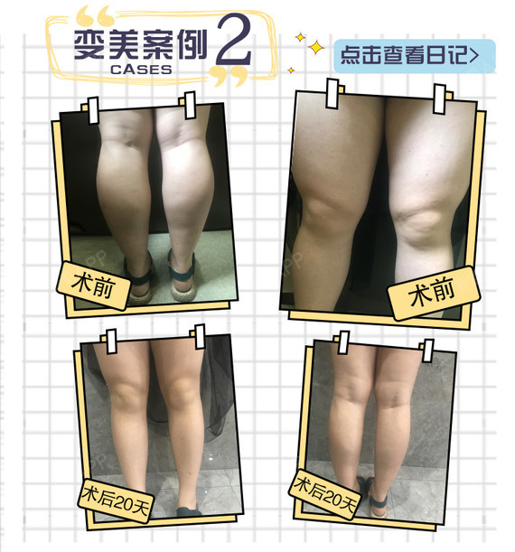 【吸脂】【首部位日记价】分层分量分点吸脂/塑形
