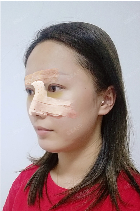 CICU鼻综合第3天美丽日记-新氧美容整形