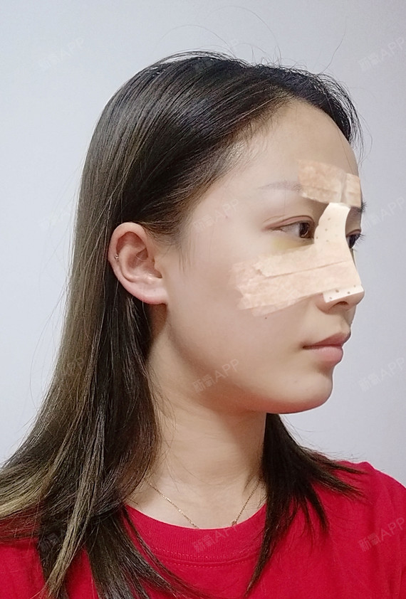 CICU鼻综合第3天美丽日记-新氧美容整形