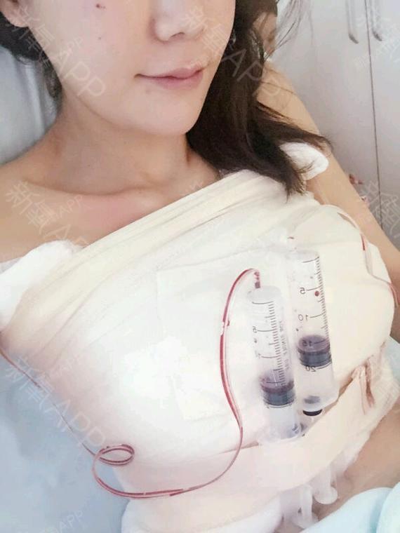 映涵沫ms假体隆胸第0天美丽日记