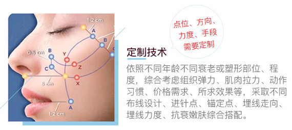 【埋线提升】童颜线雕术 鼻尖/全鼻/下颌缘/全面部 ept快速修复 持久