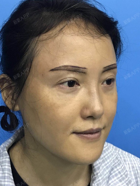 种植眉毛