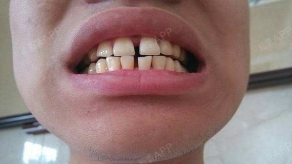 牙齿缝隙过大是什么原因导致的
