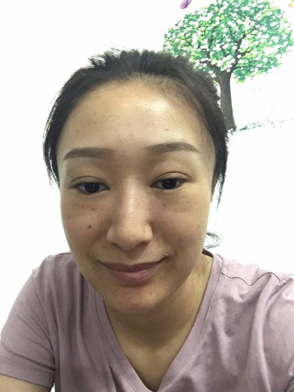 长沙雅美医疗美容医院水光针怎么样_恢复过程_效果_6.