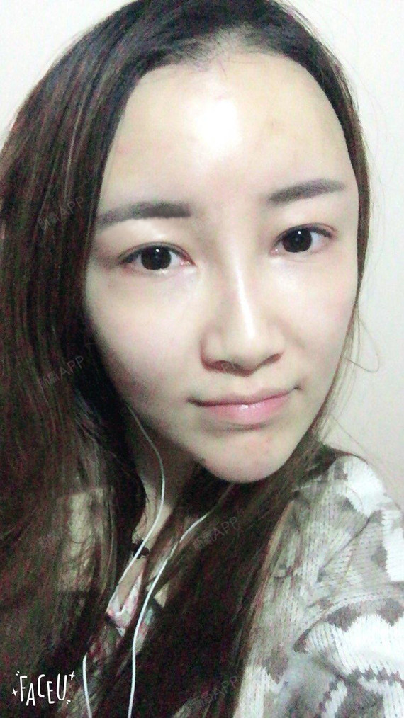 氧气xr5p1果酸焕肤第3天美丽日记-新氧美容整