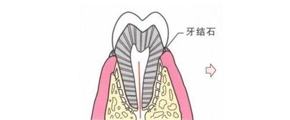 牙结石自己掉了?是惊喜还是惊吓?!如何处理牙