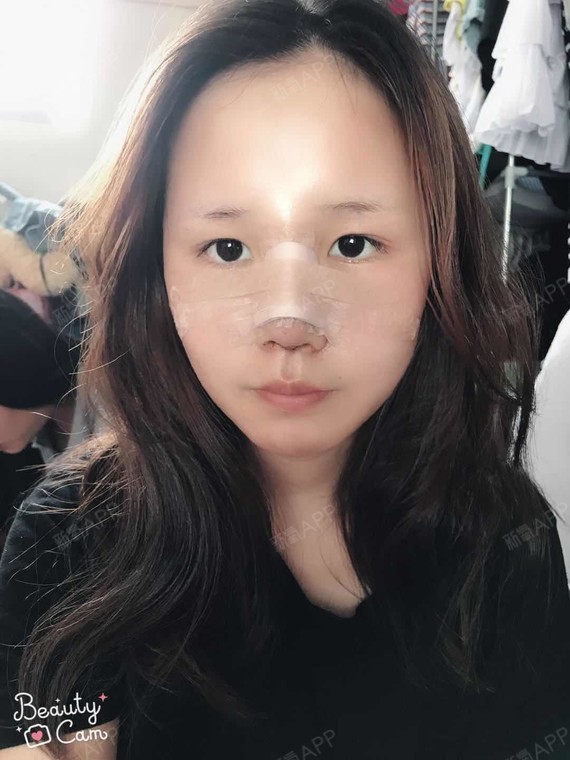 柔绚987鼻综合第3天美丽日记-新氧美容整形