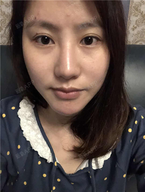【生长因子取出修复】5年,它就像一个噩梦一直纠缠着我!