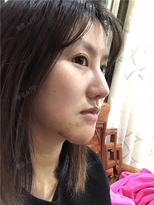 【生长因子取出修复】5年,它就像一个噩梦一直纠缠着我!