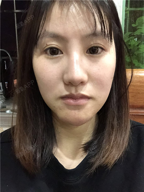 【生长因子取出修复】5年,它就像一个噩梦一直纠缠着我!