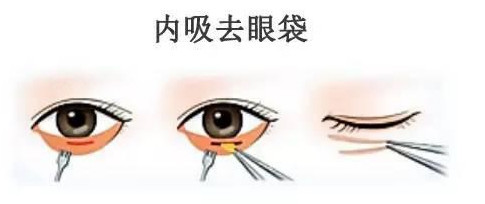 内吸去眼袋怎么样?内吸祛眼袋,主要适合单纯脂