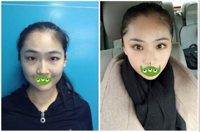 内吸去眼袋怎么样?内吸祛眼袋,主要适合单纯脂