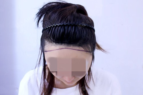 唐小夕种植发际线第0天美丽日记-新氧美容整形