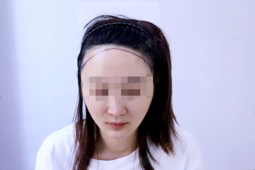 唐小夕种植发际线第0天美丽日记-新氧美容整形