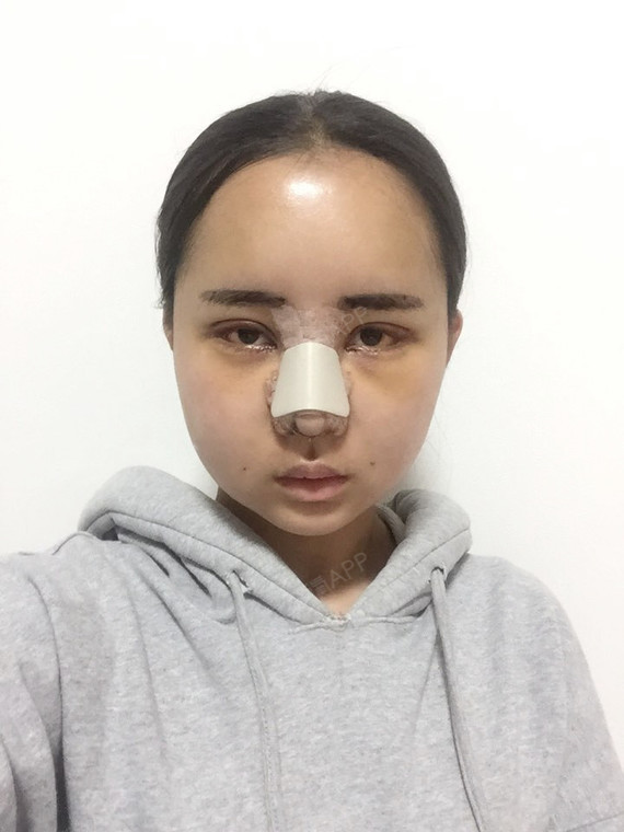 牵线鱼鼻综合第4天美丽日记-新氧美容整形