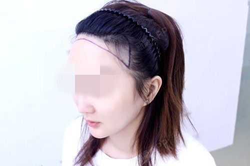 唐小夕种植发际线第0天美丽日记-新氧美容整形