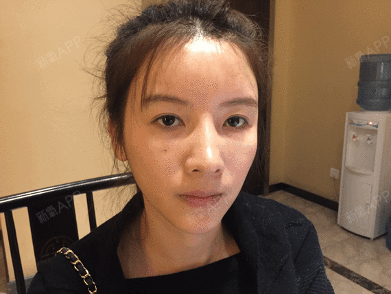 做眼睛比较多,发现一个现象,很多女孩子年纪轻轻就有泪沟.