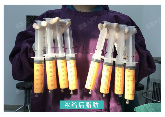 很多求美者经常问光纤溶脂与吸脂手术哪个好,