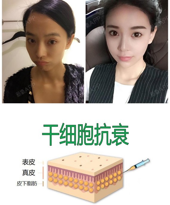 胸部 | 皮肤 | 韩国整形 | 整形纯干货 | 自体脂肪填充 | 干细胞