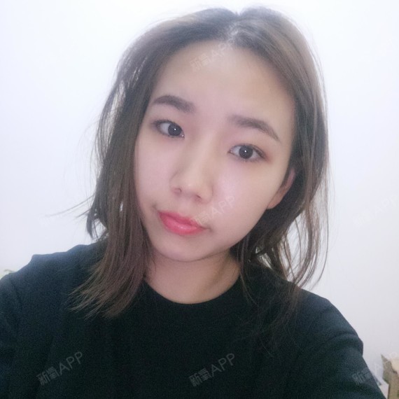 上海科发源医疗美容种植发际线第22天美丽日