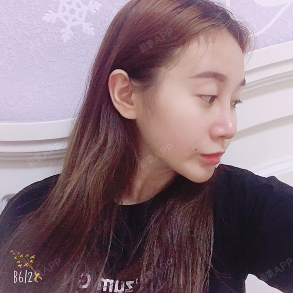 撒有那拉鼻综合第136天美丽日记-新氧美容整形