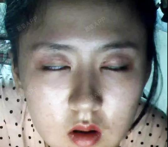 女子割双眼皮失败,造成无法闭眼