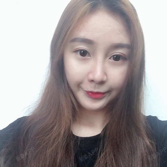 撒有那拉鼻综合第136天美丽日记-新氧美容整形