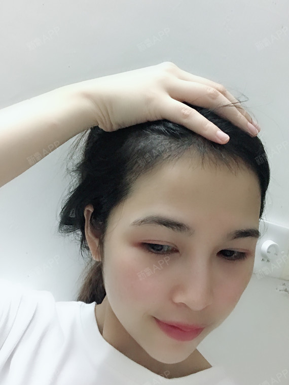 上海科发源医疗美容种植发际线第94天美丽日