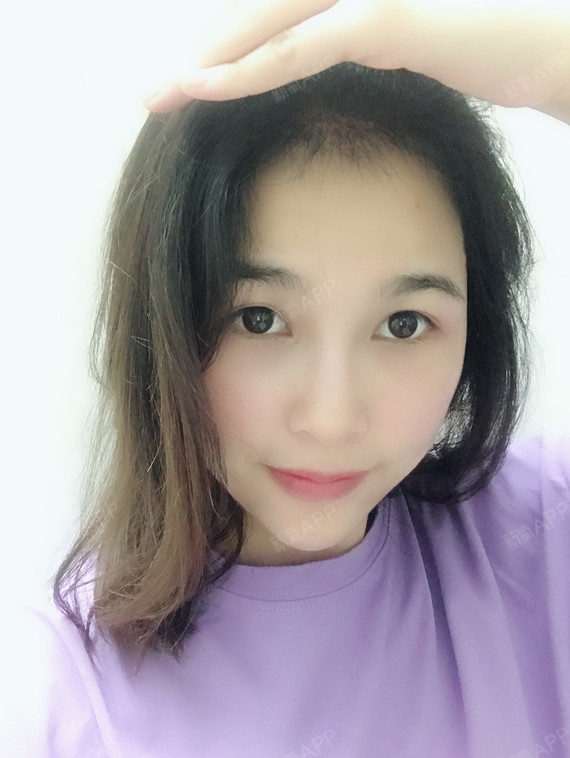 上海科发源医疗美容种植发际线第94天美丽日