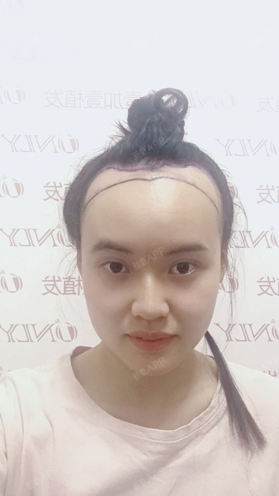 种植发际线