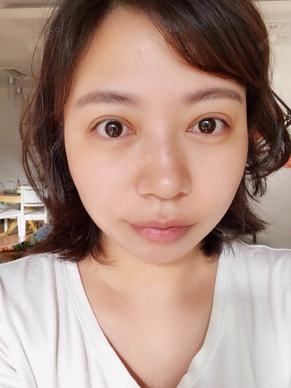 上眼睑 | 上眼睑去脂 | 眼部修复 | 重庆同城 | 定点双眼皮 | 眼部