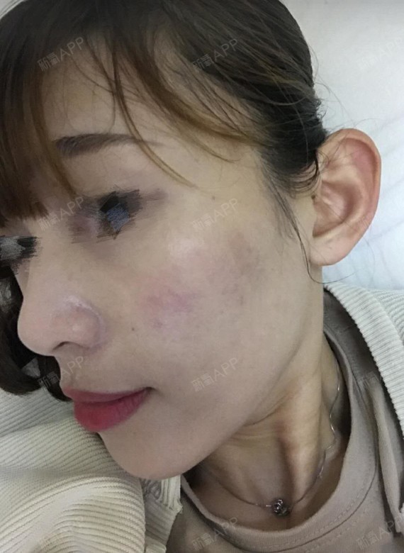 路七酱点阵激光第91天美丽日记-新氧美容整形