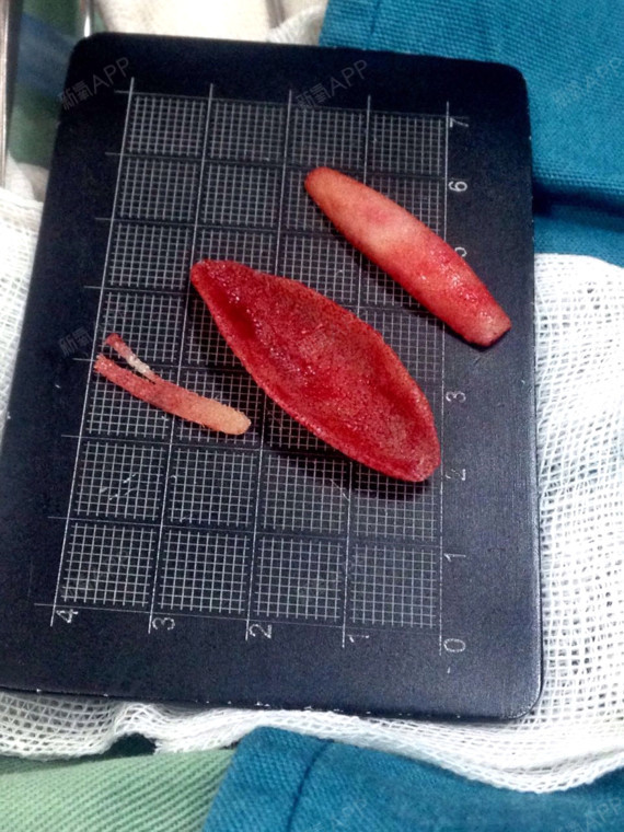 假体隆鼻10年后,你的鼻子经历了什么?