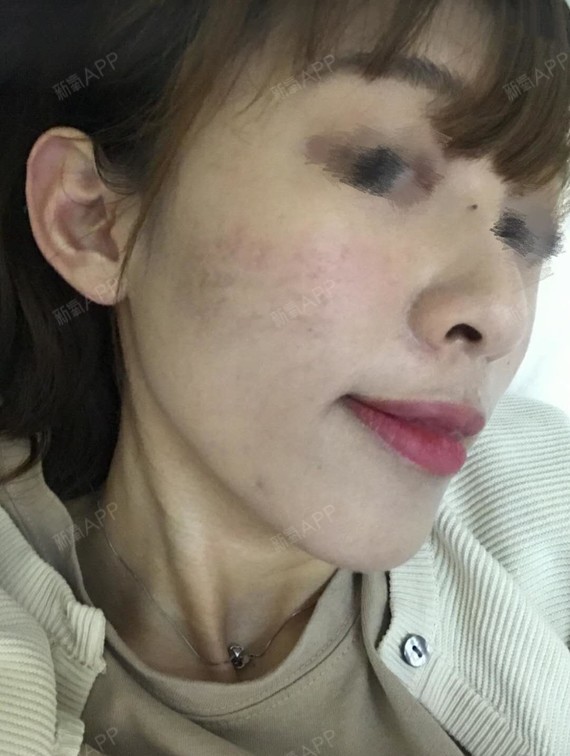 路七酱点阵激光第91天美丽日记-新氧美容整形