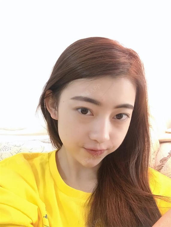 阳光下的泡沫i激光去眼袋第17天美丽日记-新氧