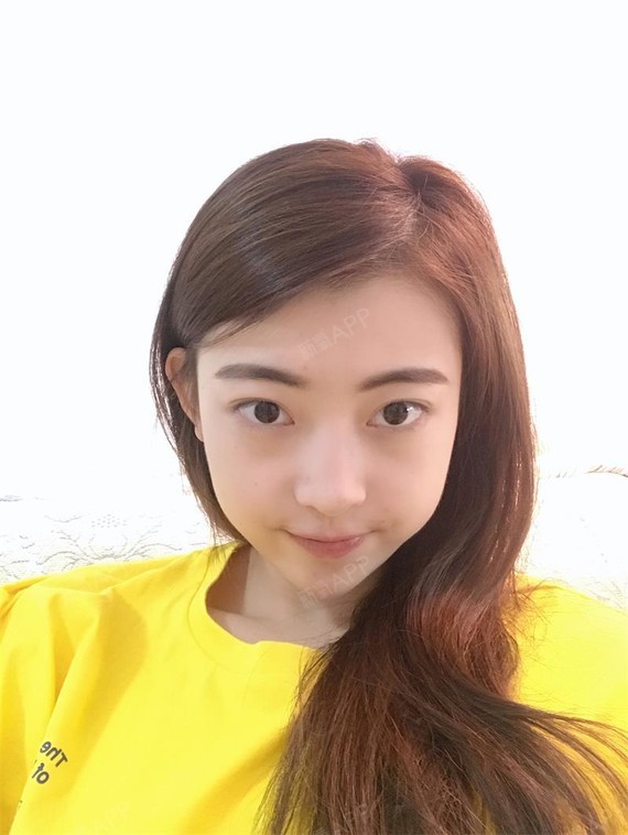 阳光下的泡沫i激光去眼袋第17天美丽日记-新氧