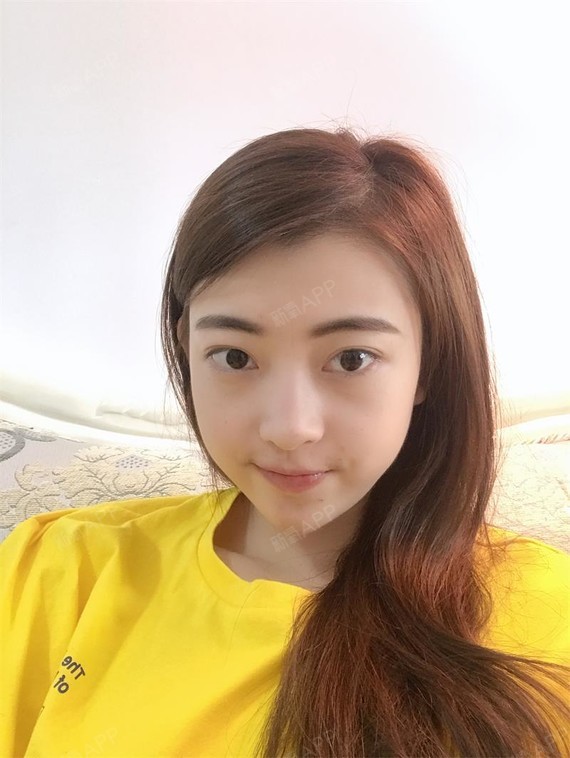 阳光下的泡沫i激光去眼袋第17天美丽日记-新氧