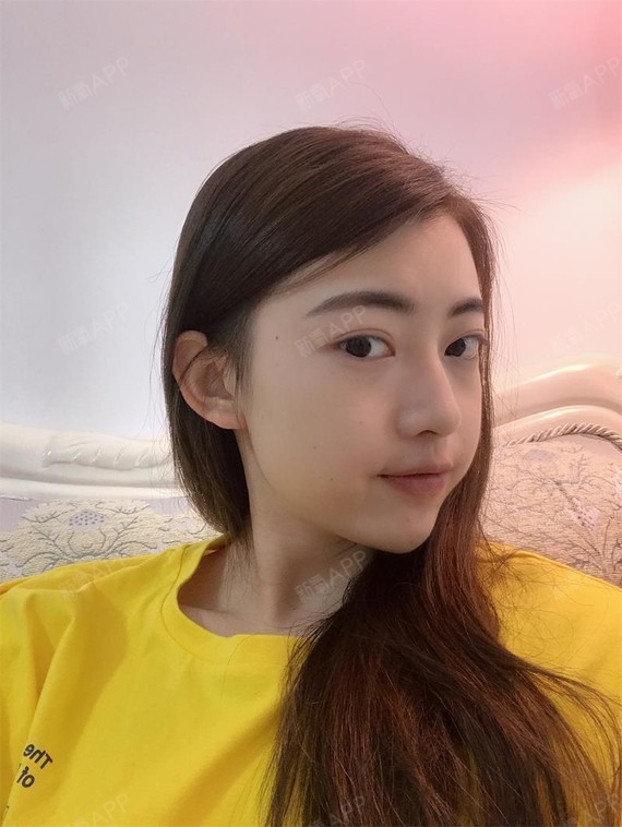 阳光下的泡沫i激光去眼袋第17天美丽日记-新氧