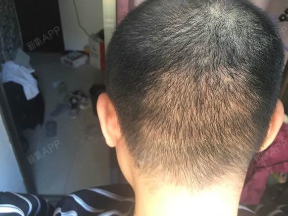 纸飞机巴拉种植发际线第31天美丽日记-新氧美