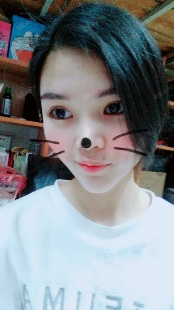 氧气xuy64定点双眼皮第30天美丽日记-新氧美容