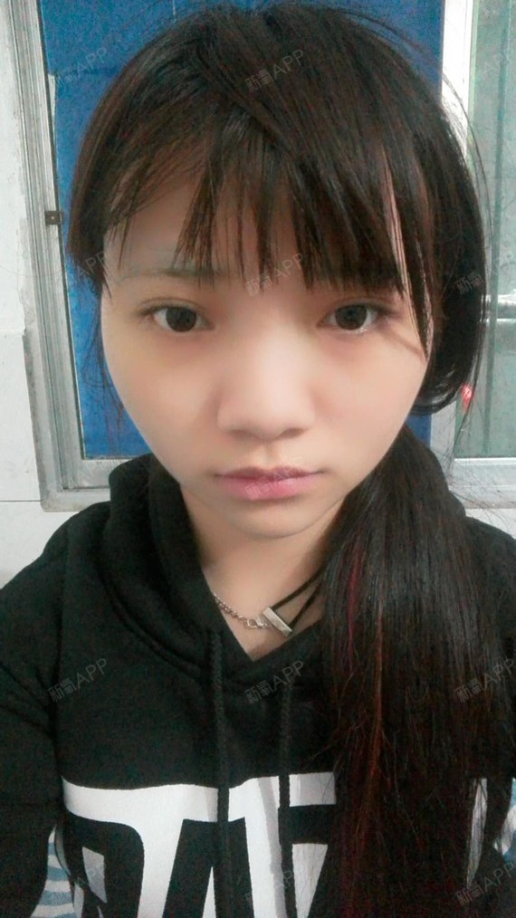 一招鉴定你的鼻翼肥大吗?