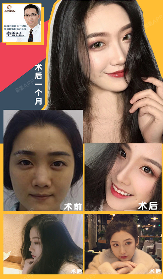 【鼻综合】【爆款】明星全立体生态小翘鼻 院长亲诊 鼻假体取出 修复