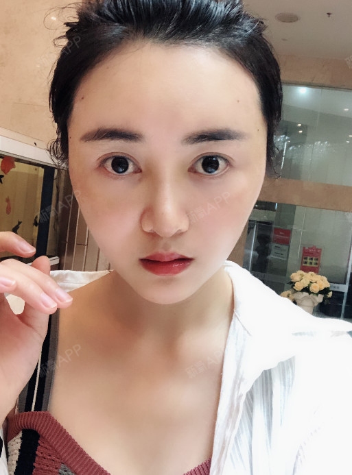 小水猫自体脂肪全脸填充第9天美丽日记-新氧美