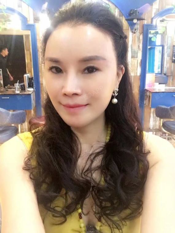 湖南姐姐鼻部硅胶假体取出第156天美丽日记-新