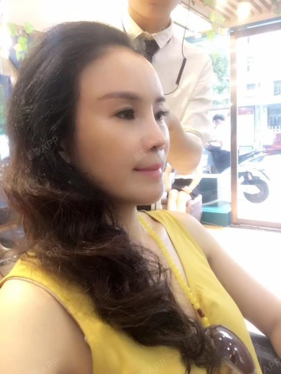 湖南姐姐鼻部硅胶假体取出第156天美丽日记-新