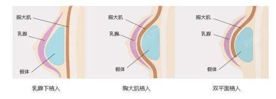 假体隆胸手术会不会影响乳腺乳房是女性最重要的性