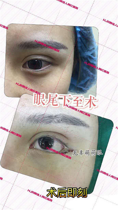 关于"下睑下至"   这是一个新兴的项目,这个名称起源于日本,下眼下至