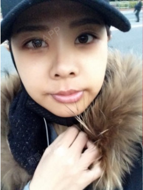 生而为nn自体脂肪全脸填充第31天美丽日记-新