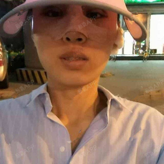 宝宝听话鼻综合第0天美丽日记-新氧美容整形