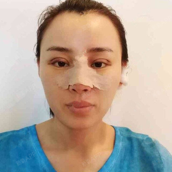 宝宝听话鼻综合第0天美丽日记-新氧美容整形